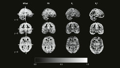 Voxel-wise reliability estimates of four multiparameter mapping parameters in gray matter
